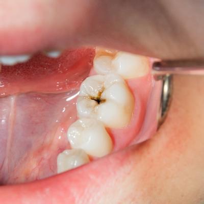 수면으로 충치 치료 하루에 가능한가요?