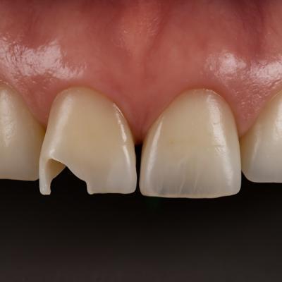 앞니가 부러졌어요, 임플란트 가능한가요?